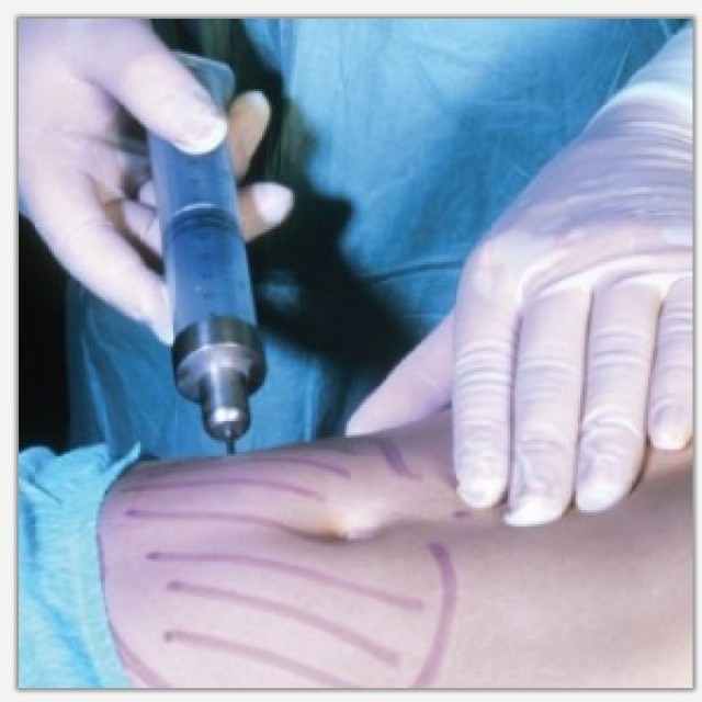 lipo