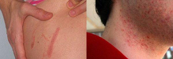 Razor burn Razor burn