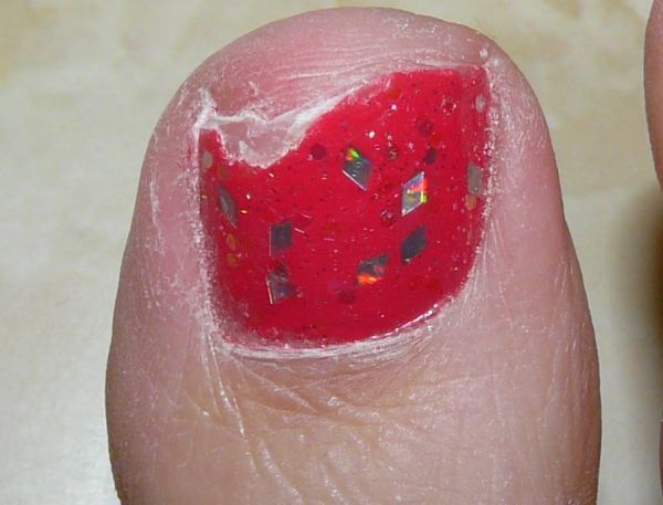 How to repair cracked toenail with acrylic. More articles by admin »