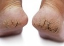 Taking care of cracked heels at home