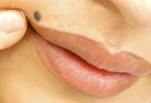 skin moles